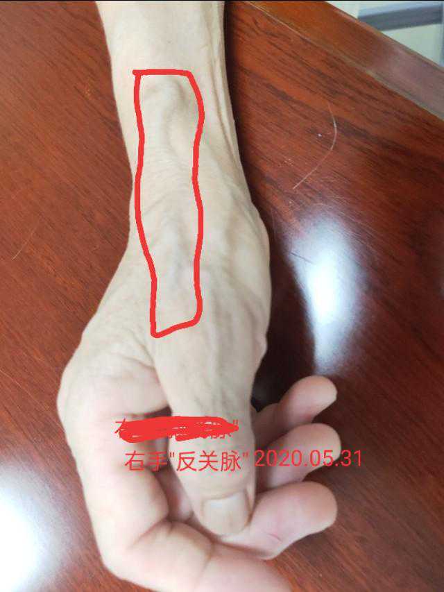临床难得一见的"反关脉"